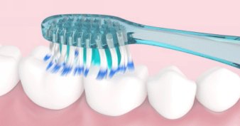 Brossage des dents avant la pose de la gouttière