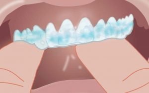 Mise en place de la gouttière sur les dents
